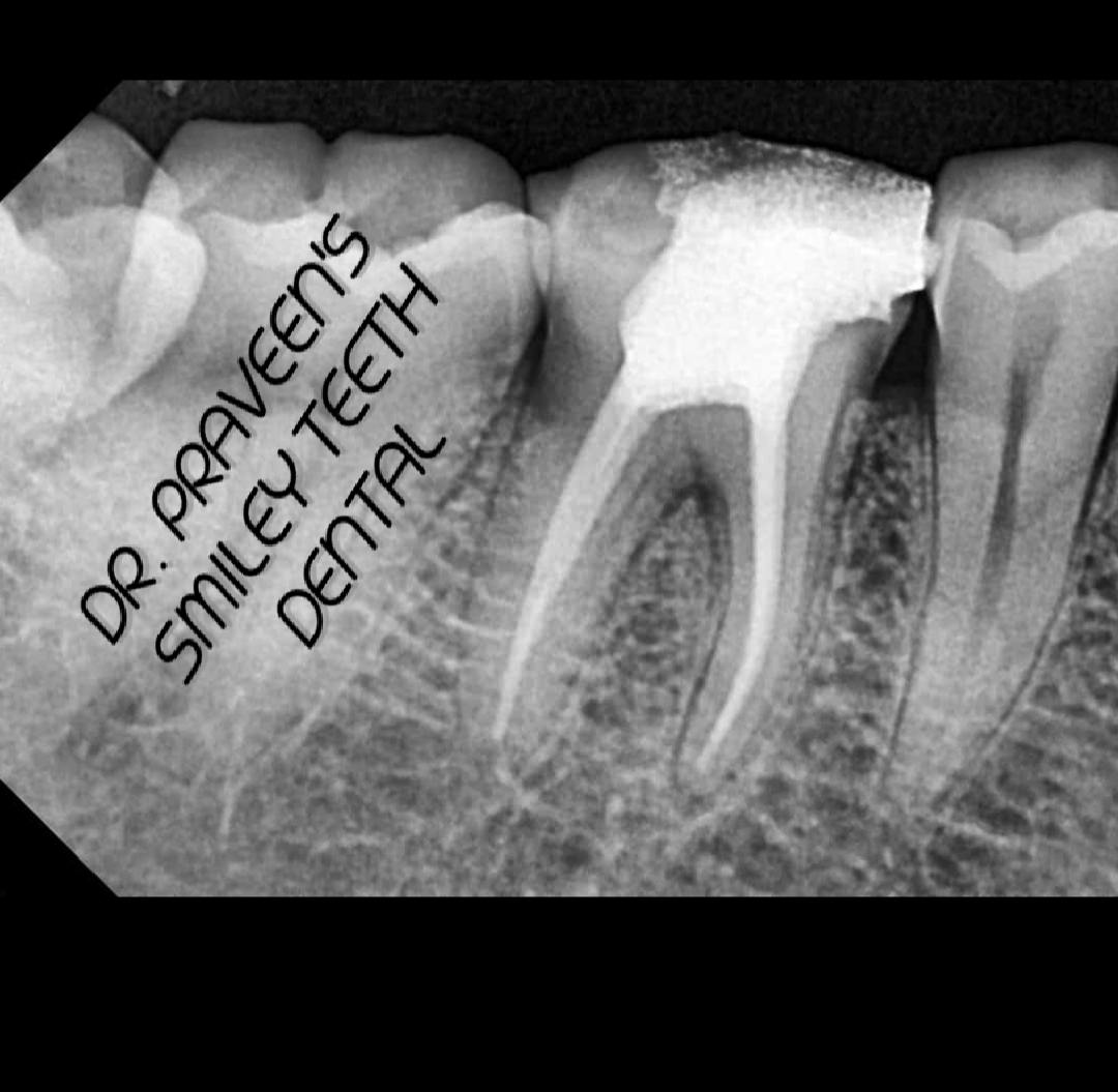 Root Canal Treatment